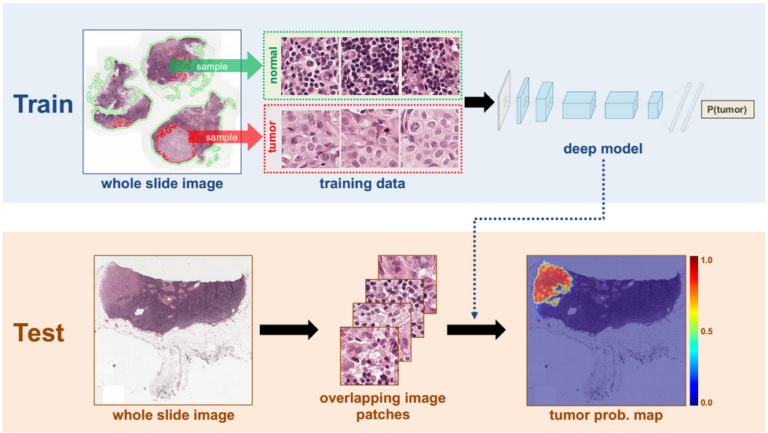 Deep Learning System Improves Breast Cancer Detection